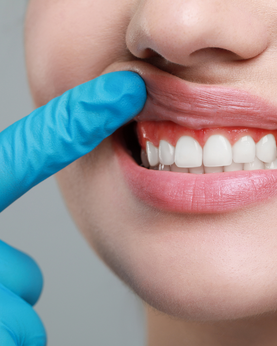 Bolest desni – simptomi, faze i mogućnost liječenja