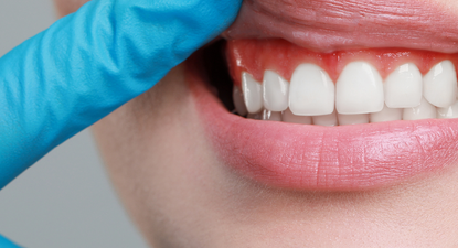 Bolest desni – simptomi, faze i mogućnost liječenja