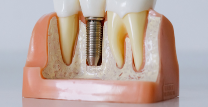 Mostovi vs. implantati – koja je razlika i što je bolje za Vas?