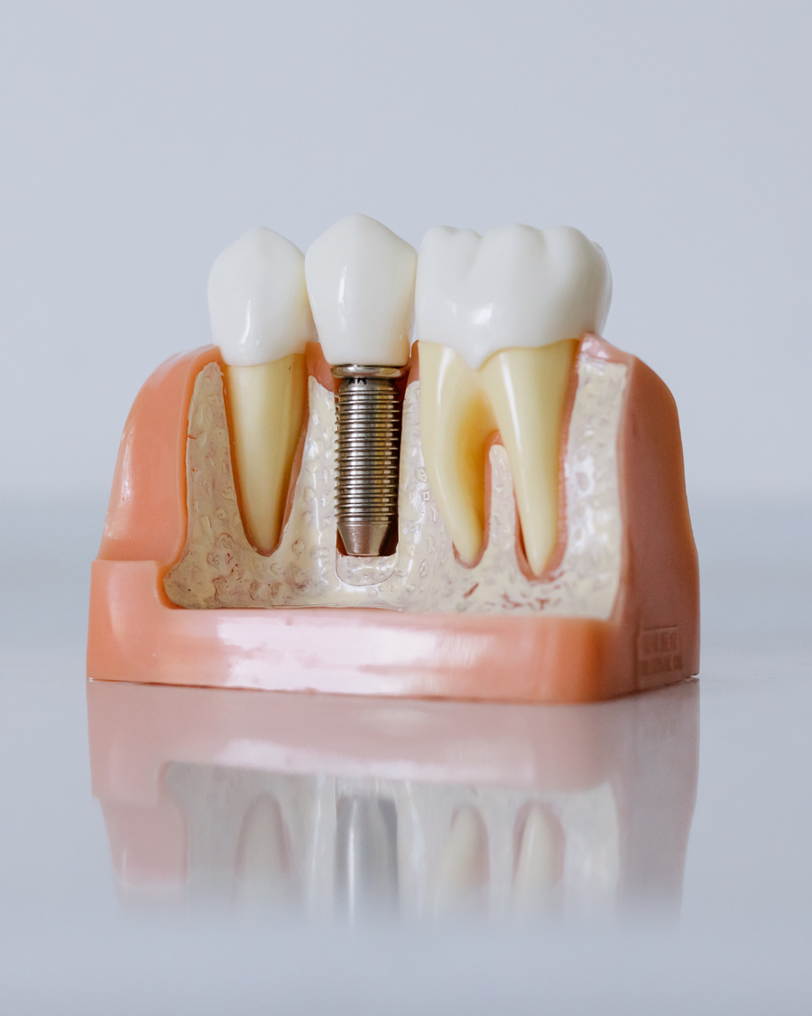 Mostovi vs. implantati – koja je razlika i što je bolje za Vas?