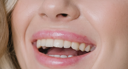 Kako oblikovanje zubnog mesa može uljepšati vaš osmijeh?