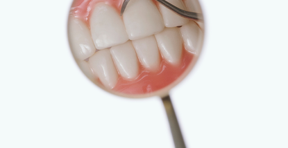 Uklanjanje kamenca i poliranje korijena