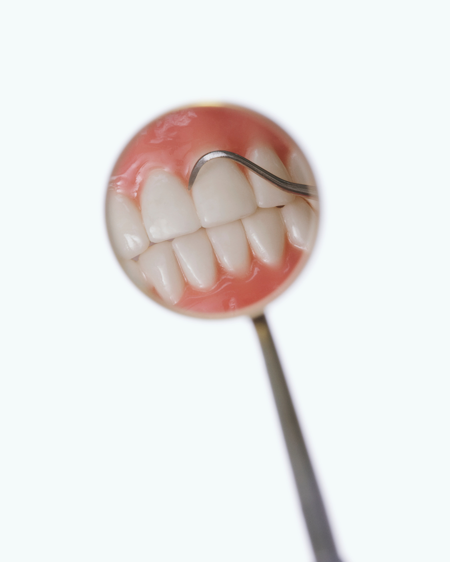 Uklanjanje kamenca i poliranje korijena